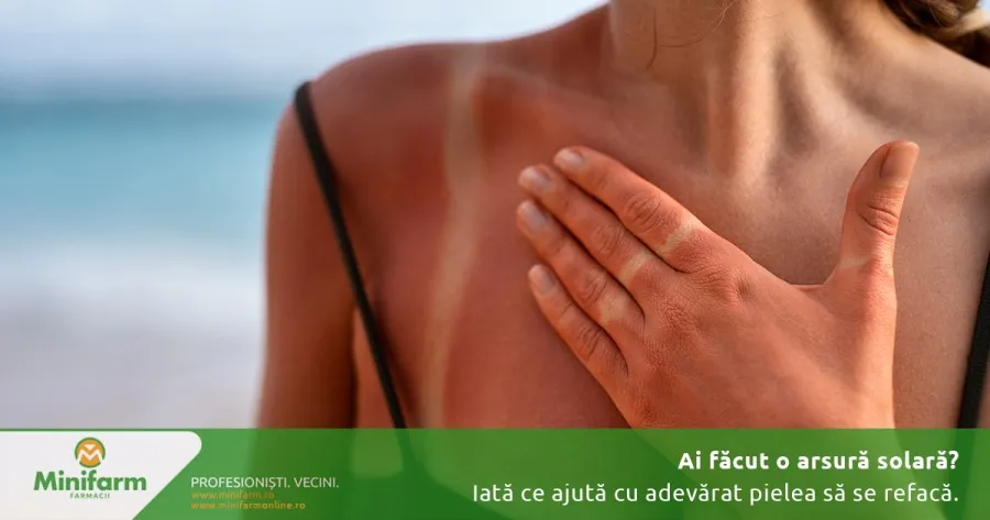 Ai făcut o arsură solară? Iată ce ajută cu adevărat pielea să se refacă