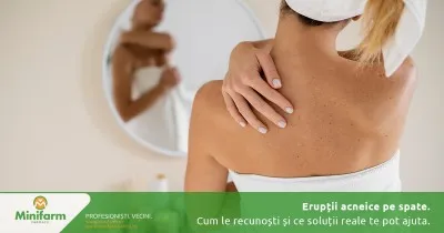 Erupții acneice pe spate: de ce apar, cum le recunoști și ce soluții reale te pot ajuta
