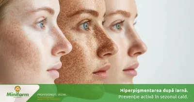 Hiperpigmentarea după iarnă: prevenție activă în sezonul cald